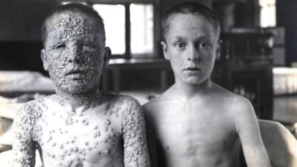 Picture of two kids. The left one didn't receive the smallpox vaccine and has smallpox all over him, the right one has received the vaccine and is not infected.